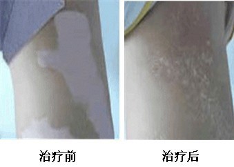 得了白癜风的早期症状图片有哪些